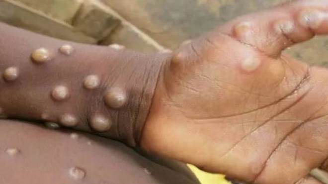 Brasil tem 17 casos confirmados para a varíola dos macacos