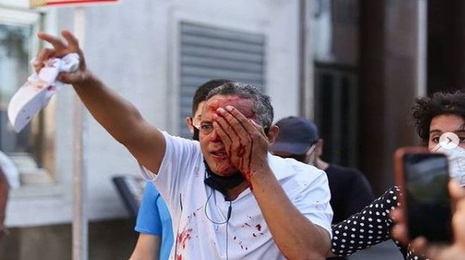 Homem perde visão de um olho após ser atingido por bala de borracha disparada em ato contra Bolsonaro no Recife