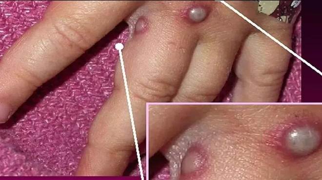 Secretaria de Saúde da Bahia emite alerta sobre sintomas da varíola dos macacos