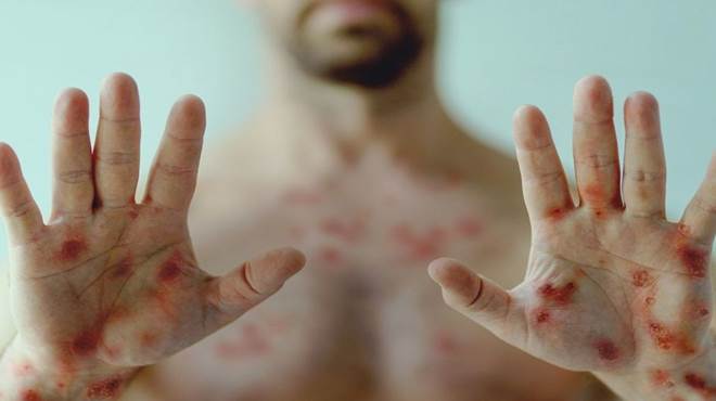 Brasil já é o terceiro país com mais casos de varíola dos macacos do mundo