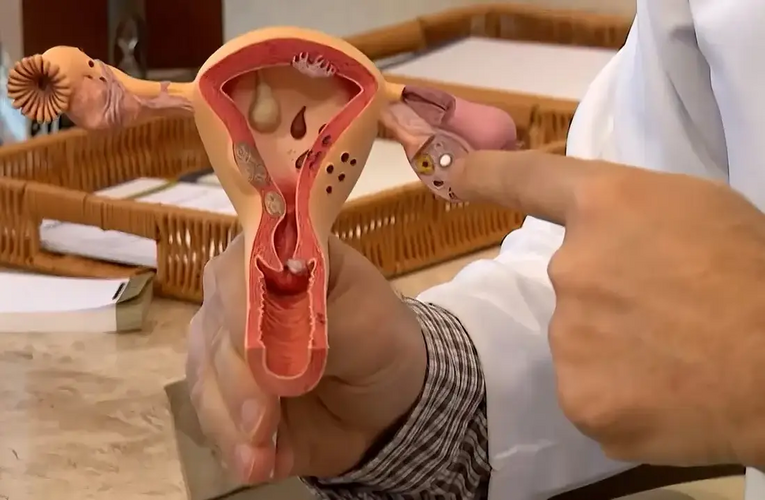 Endometriose: conheça os sintomas e saiba como tratar a doença