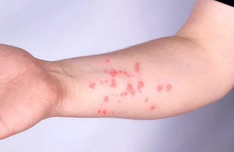 Saúde confirma primeiro caso de nova cepa de mpox no Brasil